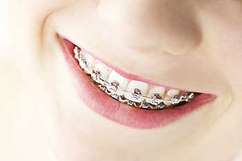 New Hyde Park Dental Braces