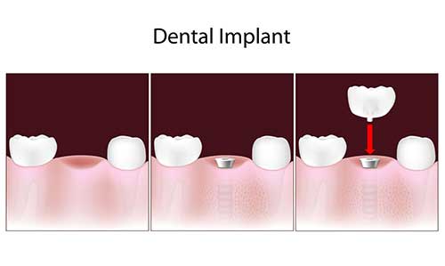 Implant Dentist in New Hyde Park
