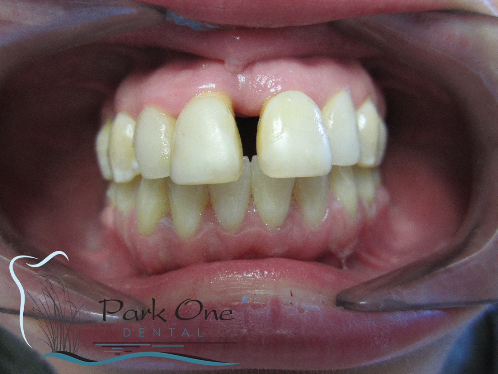 New Hyde Park Before and After Teeth Whitening