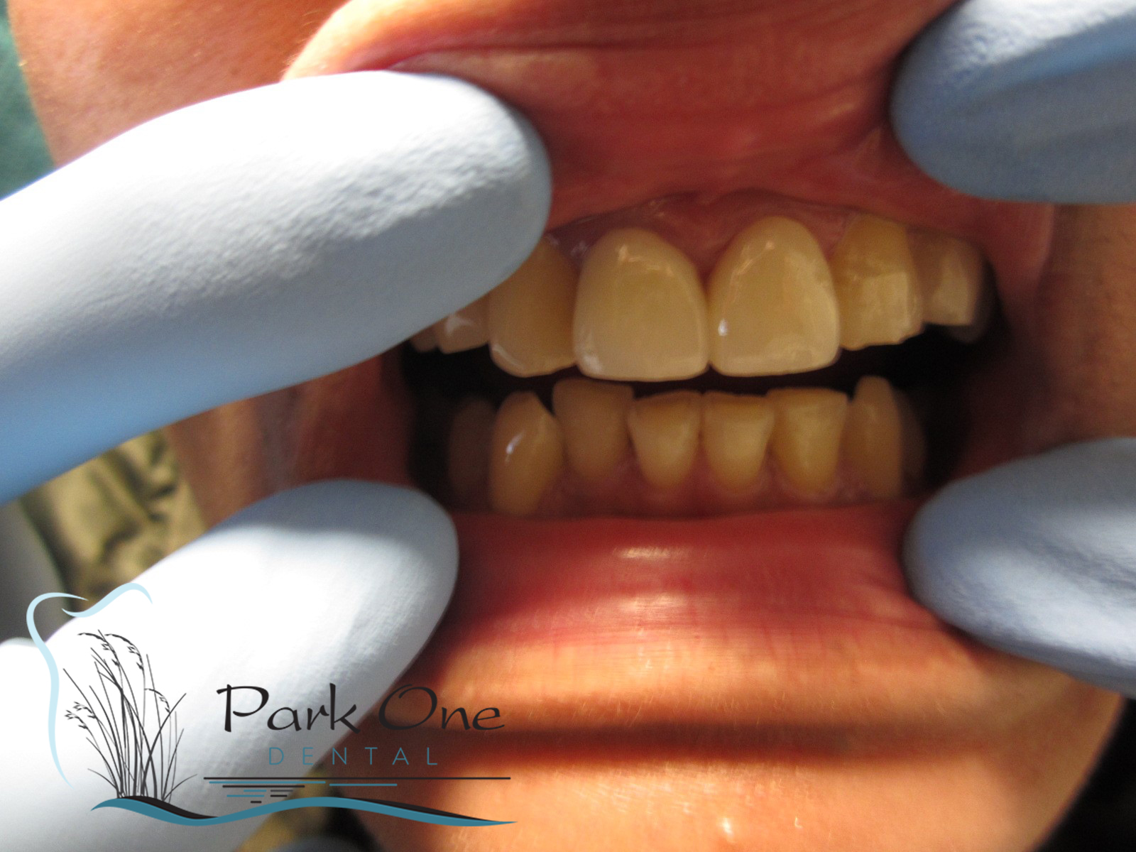 Garden City Before and After Teeth Whitening