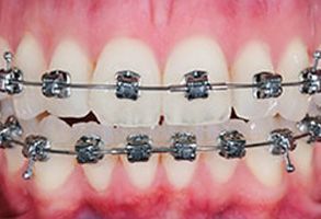 Garden City Before and After Teeth Whitening