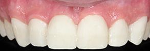 Before and After Dental Implants near Garden City