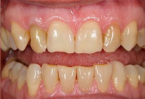 Floral Park Before and After Dental Implants